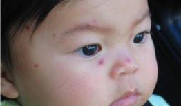 水痘可以吃小瓜,小瓜助力健康恢复